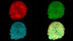 Representative confocal images of TP53-R175H-mutant patient-derived organoids